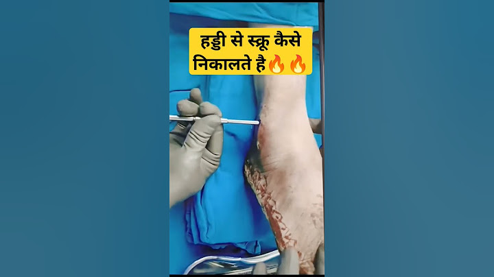 हड्डी Bone से Screw निकाल दिया 🔥🔥| #fracture #fracturerecovery #bonepain #fractures #orthopedics