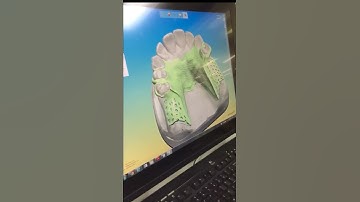 CADCAM DIGITAL PARTIAL - By Drake Lab