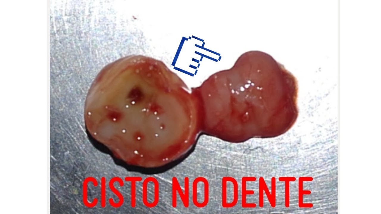 😱CISTO | BOLHA NO DENTE - Pode acabar com dentes e ossos! - YouTube