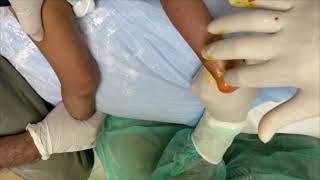 Percutaneous Achilles Tendon Tenotomy in Clubfoot Patients with  22 Gauge Needle | IHHN screenshot 1