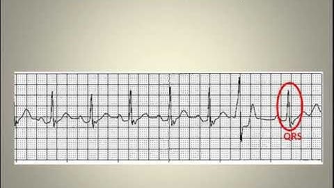 ECG Interpretation Video Lecture Module 3-B of 6