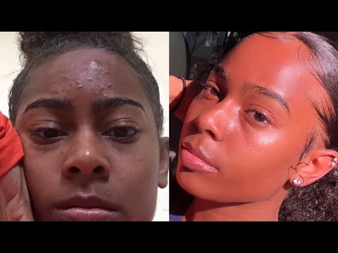 easy-skin-care-routine-|-how-i-got-rid-of-severe-acne-fast-|-affordable|-everyday-skin-routine|
