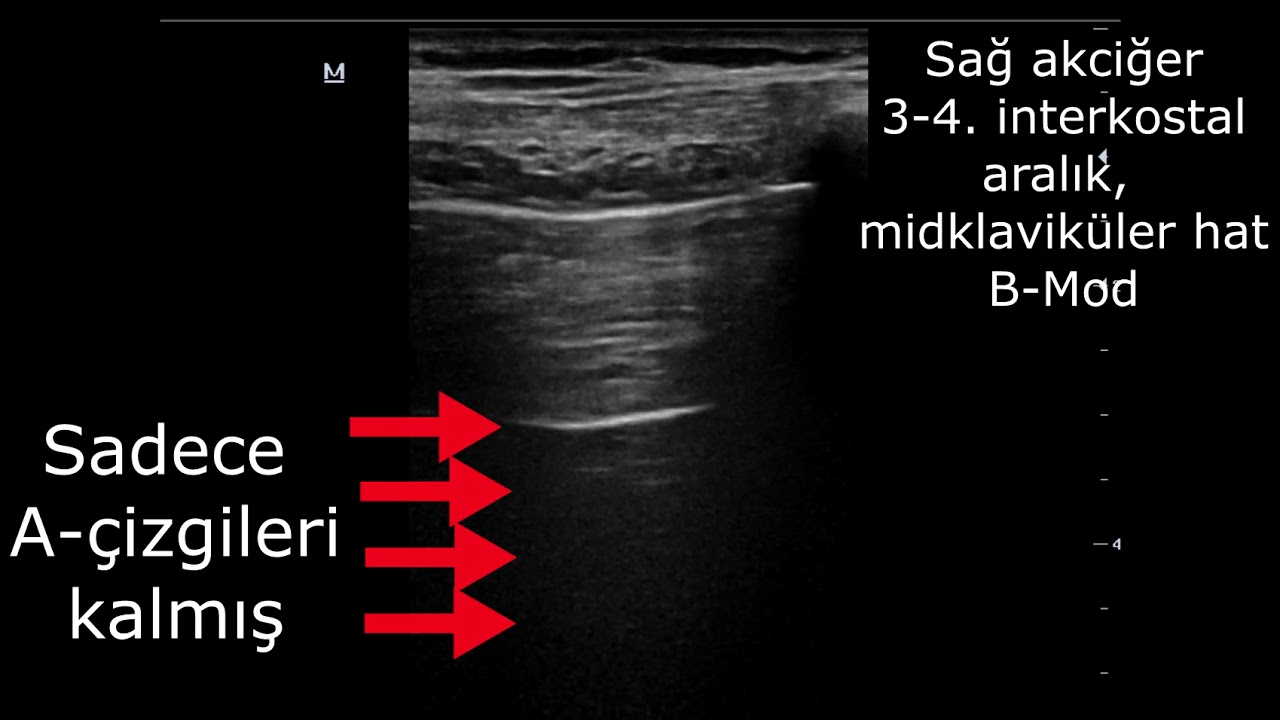 Pnömotoraks'a Yönelik Akciğer Ultrasonu