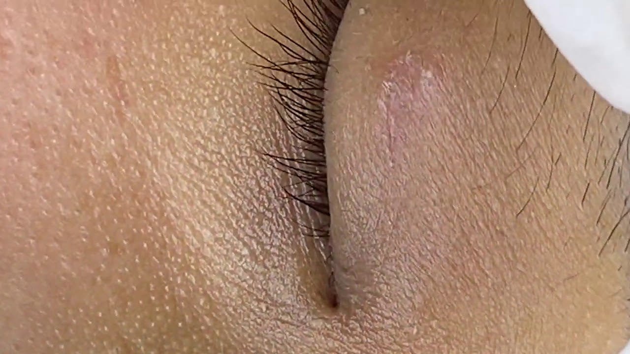 Extractions And Acne  - ThuyTruong#91