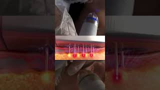 🔥 RF-лифтинг — хит среди процедур для подтяжки и молодости кожи!