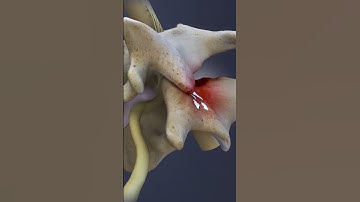 Spinal Conditions of the C6-C7 Spinal Motion Segment