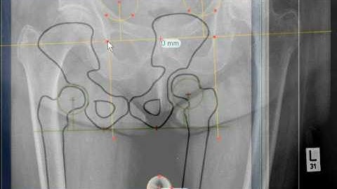 TraumaCad - Center of Rotation