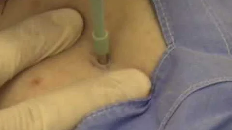 Como usar punch para biópsia?