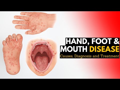 Hand, Foot, and Mouth Disease, Causes, Signs and Symptoms, Diagnosis and Treatment,