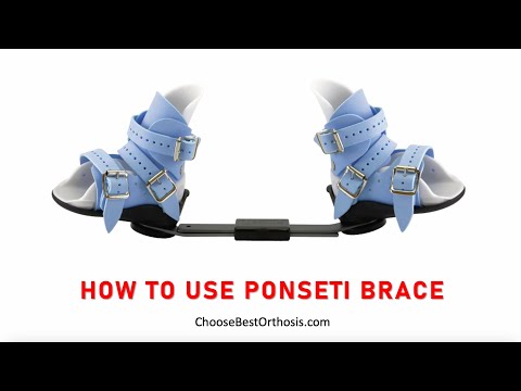 HOW TO USE PONSETI BRACE FOR CLUB FOOT TREATMENT
