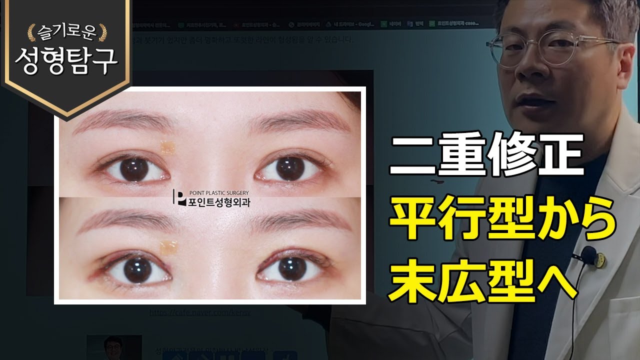 平行型から末広型へ二重修正の症例をご紹介します Youtube 平行型から末広型へ二重修正の症例をご紹介します Youtube