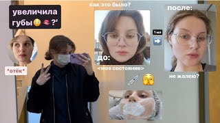 увеличила губы?! и что со мной стало🧐 сколько стоила процедура? как все прошло