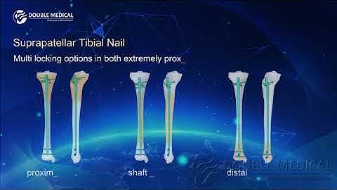 Double Medical Suprapatellar Tibial Nail