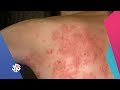 صباح النور | الحزام الناري .. الأعراض والعلاج