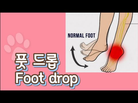 FOOT DROP    My body story treatment