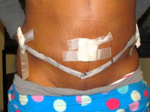 before and after tummy tuck with stretch marks before and after tummy tuck with stretch marks