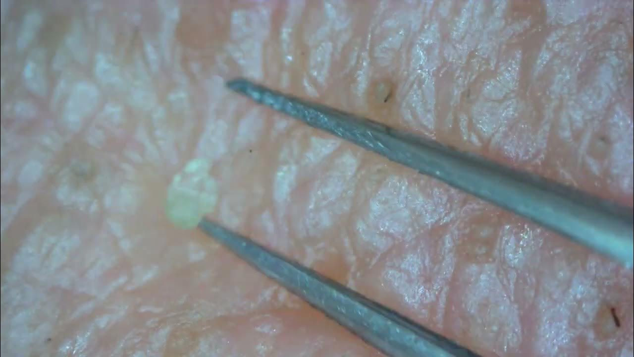 0196 keratin plug removal chin YouTube