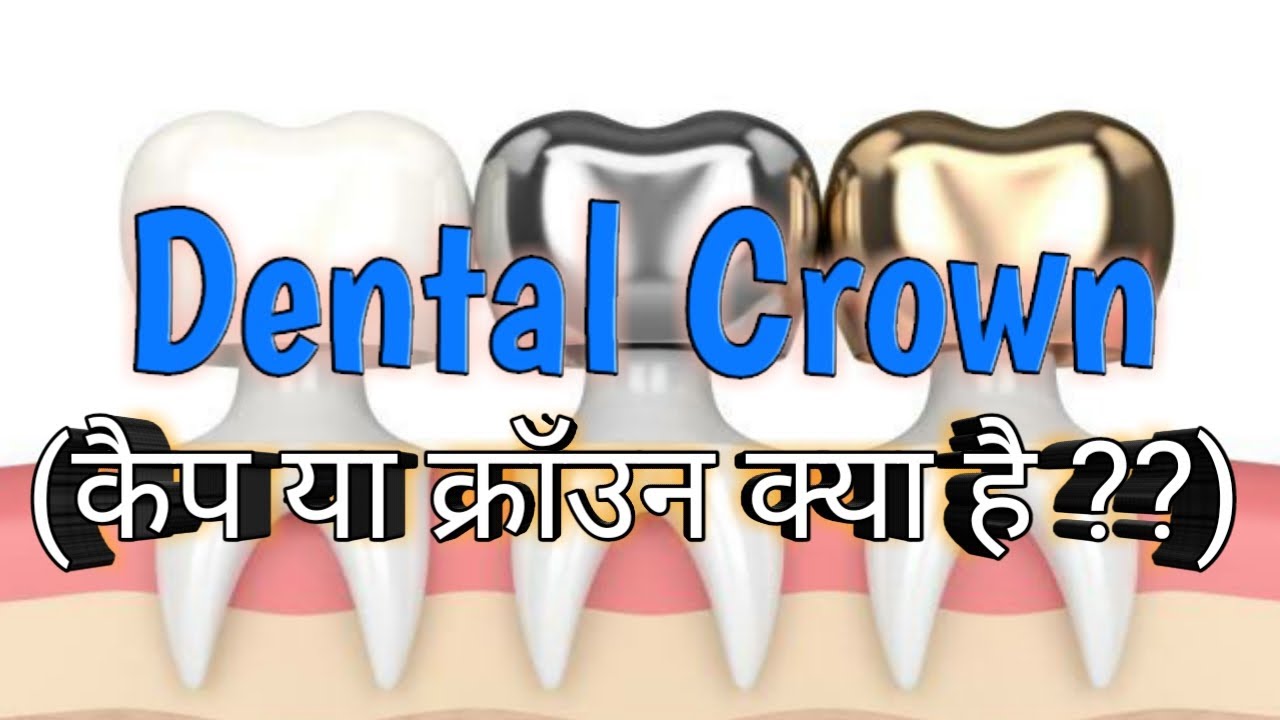 Dental Crowns Metal crowns PFM crowns Zirconia crowns Types of