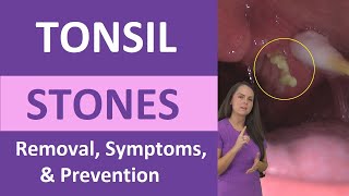 Tonsil Stones: Removal, Causes, Symptoms, Cotton Swab Treatment by RegisteredNurseRN 161,591 views 3 months ago 4 minutes, 53 seconds