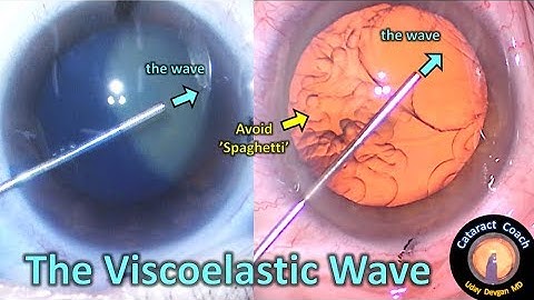 The dispersive Viscoelastic Wave in Cataract Surgery