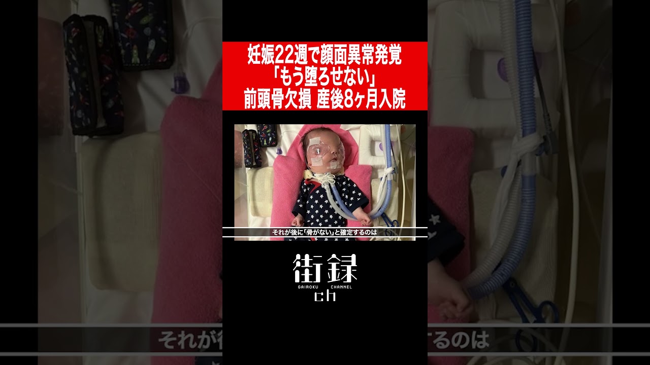 Facial abnormality discovered at 22 weeks pregnant, but