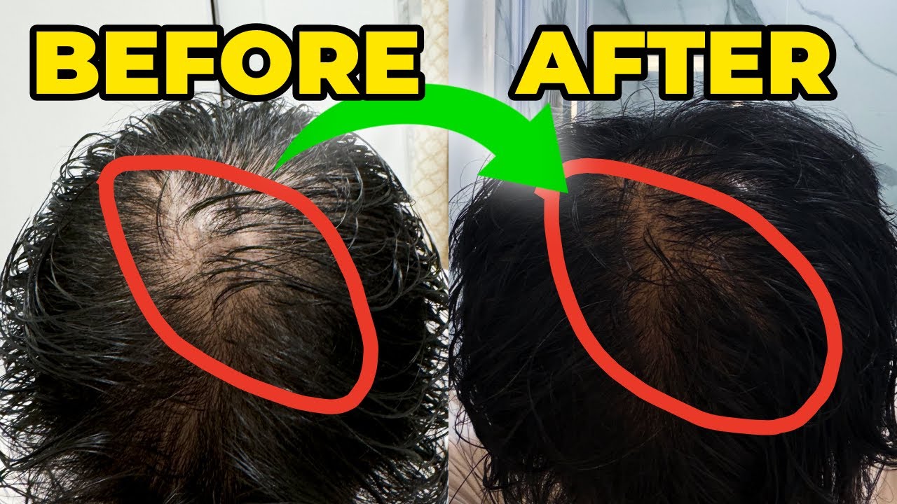 Why I switched from finasteride to dutasteride | 1 Year Later