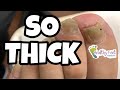 EXTREMELY THICK NAIL CUTTING AND GRINDING OF NAILS, HOW TO CUT THICK TOENAILS