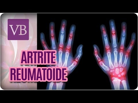 Artrite Reumatoide -