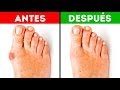 5 Consejos para eliminar el dolor de los juanetes