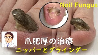 ひどい巻き爪（爪肥厚）の治療 : 治療の相談室  Ingrown toenails with Onychomycosis : Nail Fungus Scraping （爪水虫/白癬/手術/陥入爪）