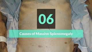 Causes of Massive Splenomegaly