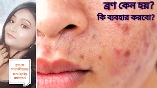 একদিনের মধ্যেই ব্রণ চলে যাবে ||  How To Remove Pimple Overnight || 6 Face Pack For Pimples Skin