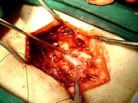 live open spine surgery gujarati explanation dr as...