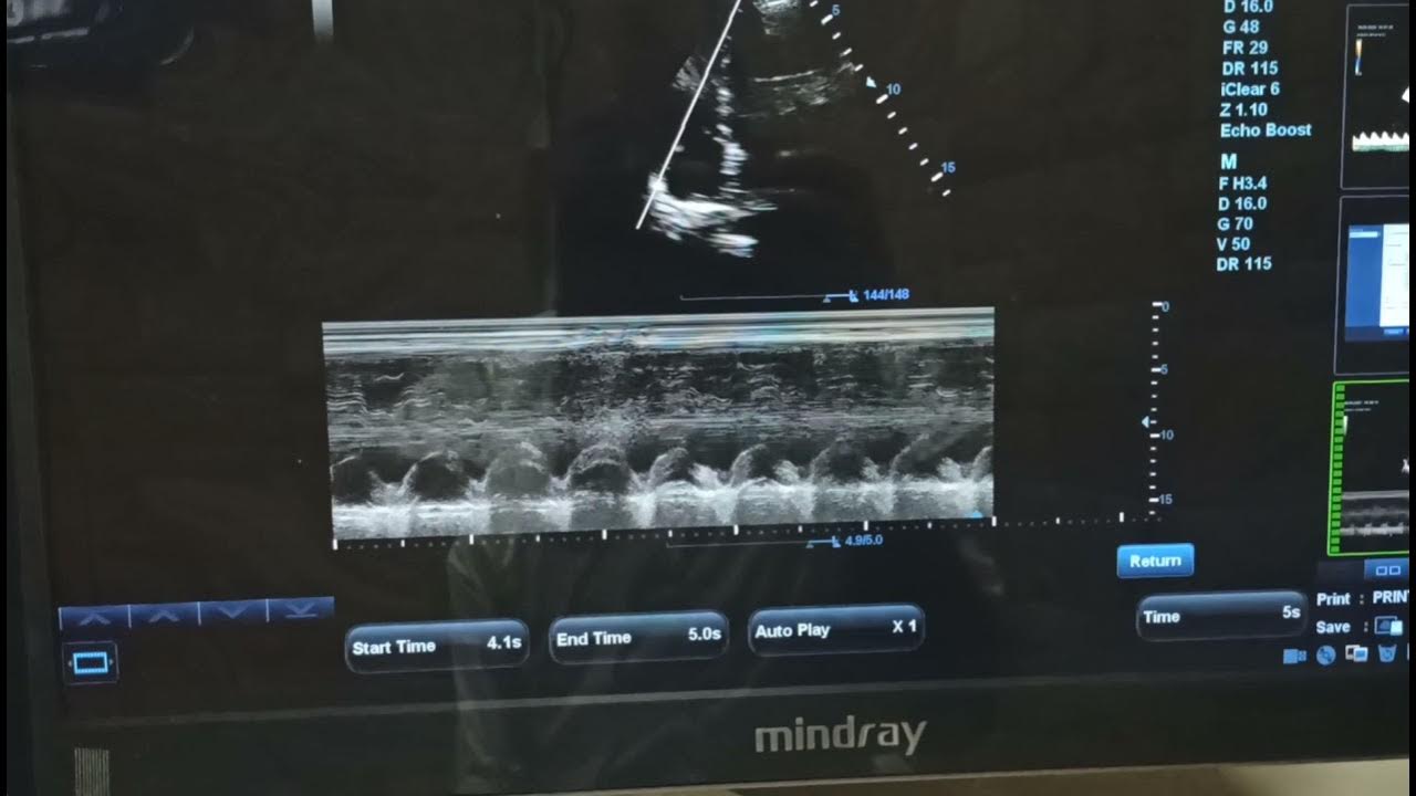 How to measure tapse , LV mass YouTube