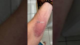 Bruisemaxxing @WhatIveLearned