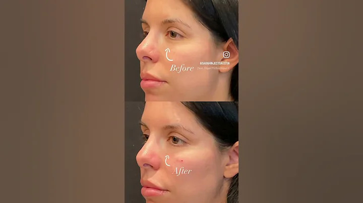 Tear trough filler should always be undetectable! 🙌