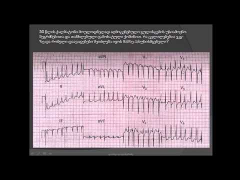 ეკგ ანალიზი /გულის რევმატიზმი / ჰიპერთირეოზი / მიტრალური ხვრელის სტენოზი / ალკოჰოლიზმი