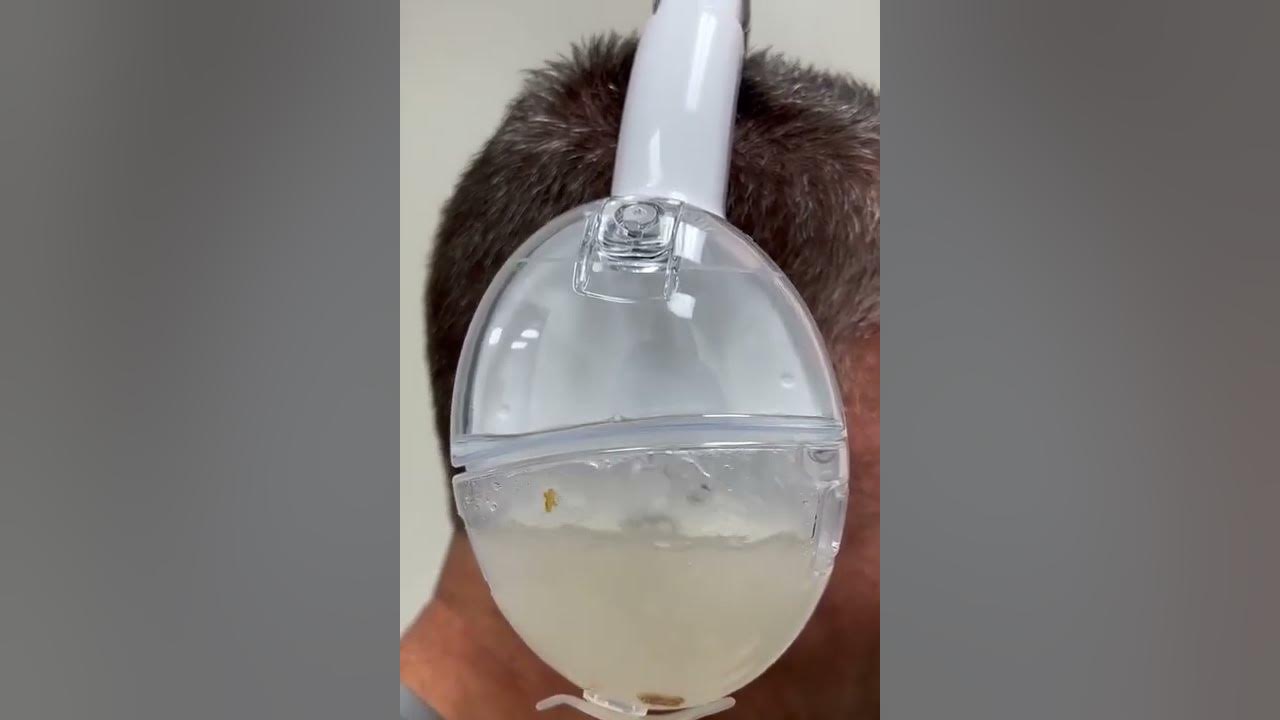 FDACleared OtoSet® Ear Cleaning System Earwax Removal Procedure