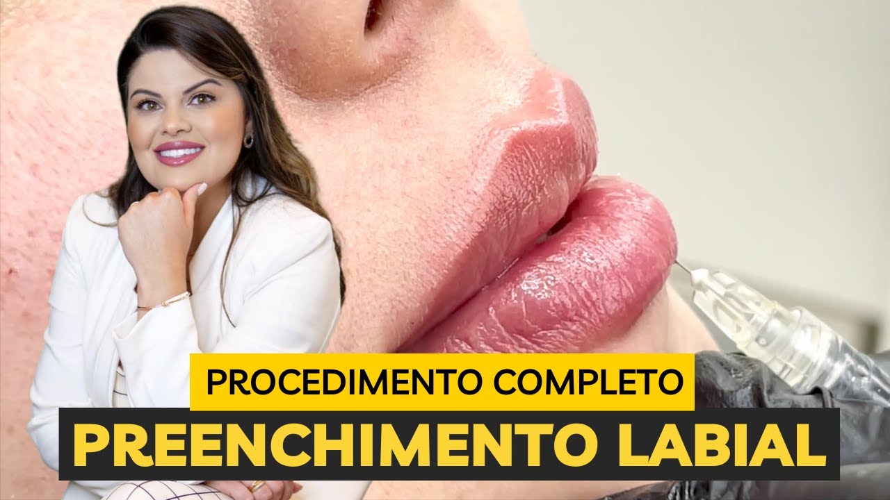 PREENCHIMENTO LABIAL | Procedimento completo e segredo pro resultado natural
