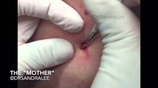 Part 2: BEST OF, April 2015 DrPimplePopper For medical education- NSFE.