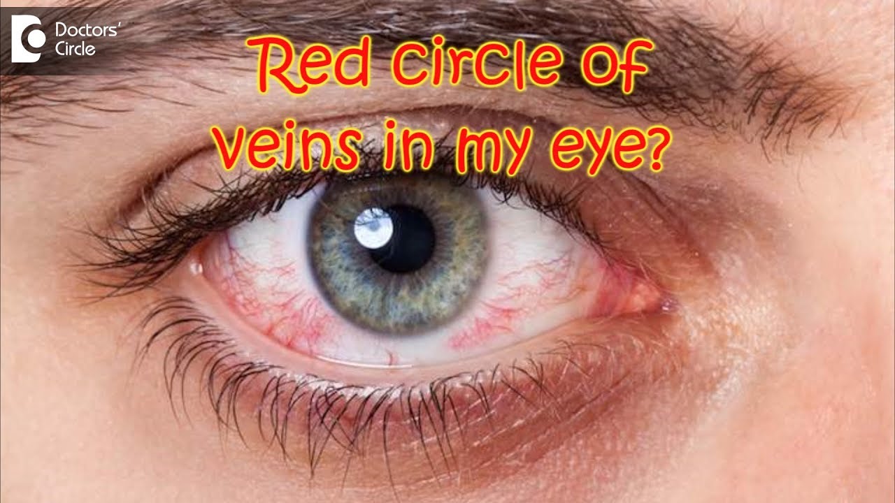 How do I get rid of the orange/red circle of veins in my eye? - Dr. Sriram Ramalingam - YouTube
