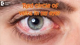 How do I get rid of the orange/red circle of veins in my eye? - Dr. Sriram Ramalingam Veins Inside Eye 5081849
