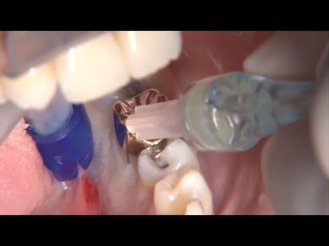 فيديو: كيف تعمل الأسنان الخالية من التخدير للكلاب؟