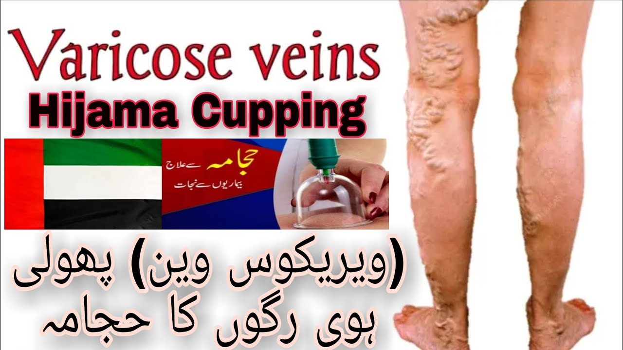 doturi pe varicose hijama