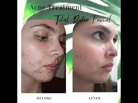 Diandra&#039;s Inspiring Journey with Acne &amp; Recovery