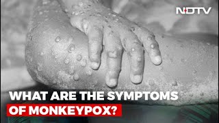 What Is Monkeypox And How Dangerous Is It?