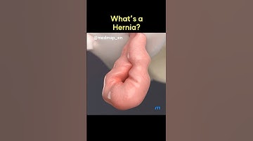 What’s a Hernia?