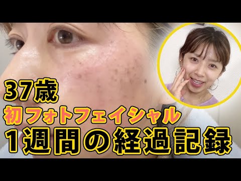 【シミ、そばかす治療】37歳主婦フォトフェイシャル初体験【アラフォー】