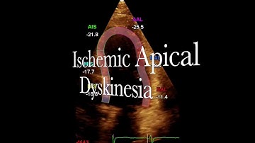 Ischemic Apical Dyskinesia