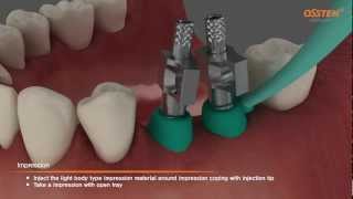 TSIII Fixture Placement &amp; Impression taking (Pick-up and Transfer Impression Copings)